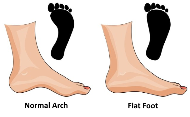 flat feet in the military