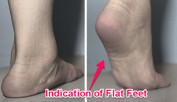 what flat feet look like in a tiptoe test