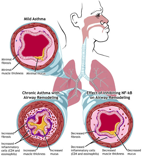 what is asthma