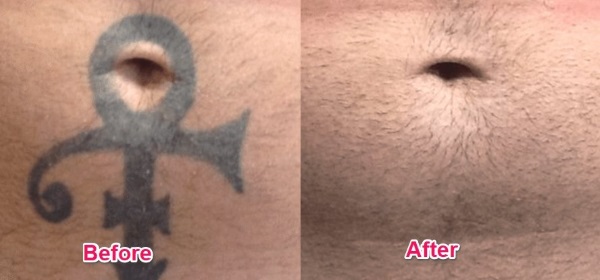 neatcell picosecond pen before and after