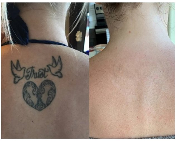 back tattoo removal before and after