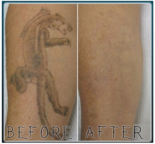 forearm tattoo removal before and after