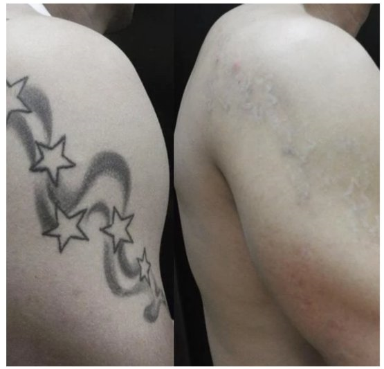 shoulder tattoo removal before and after